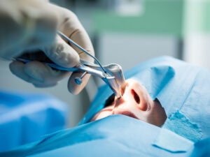 Coblation: tecnologia para cirurgia de amígdalas e adenoide com mais precisão